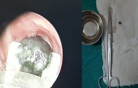 1 வயது குழந்தையின் மூச்சுக் குழாயில் சிக்கிய மிளகு: அறுவை சிகிச்சை இல்லாமல் அகற்றிய கோவை அரசு மருத்துவமனை