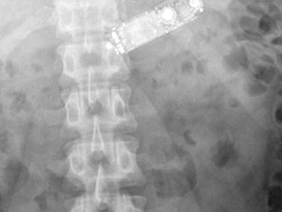 சோதனைக்கு பயந்து சிறைக் கைதி செய்த காரியம்.. இறுதியில் சோகம்.. அதிர்ச்சியில் பீகார் காவல்துறை அதிகாரிகள்!