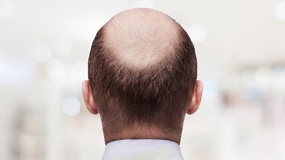 “எங்க டீம்ல வழுக்கை தலை உள்ள ஆள் வேண்டாம்..” வேலையை விட்டு நீக்கிய நிறுவனம்.. அதிரடி காட்டிய நீதிமன்றம் !