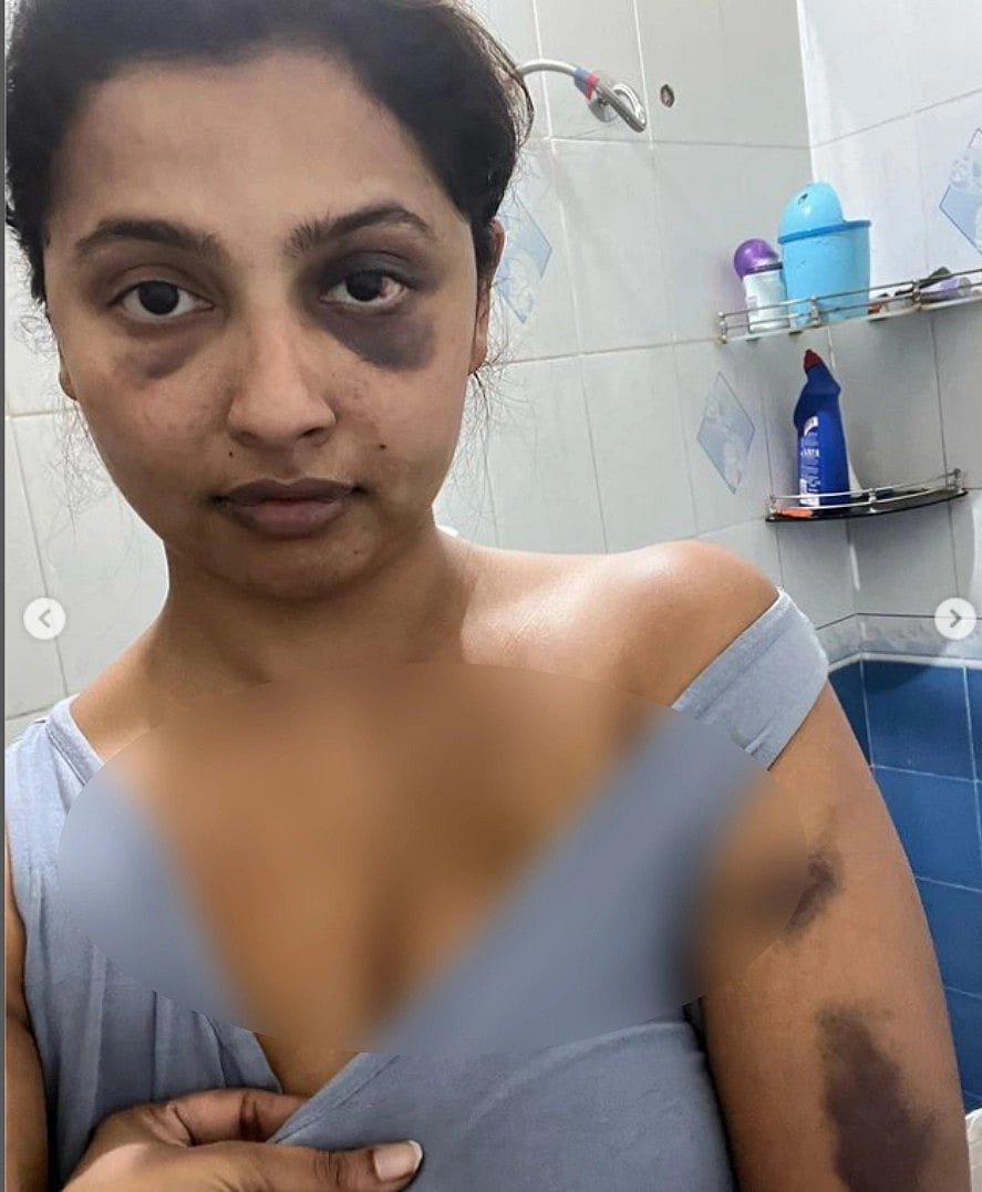 வீங்கிய முகம்.. ரத்த கோரங்களுடன் உடல்: காதலன் தாக்கியதாக இன்ஸ்டாவில் புகைப்படம் பதிவிட்ட தமிழ் பட நடிகை !