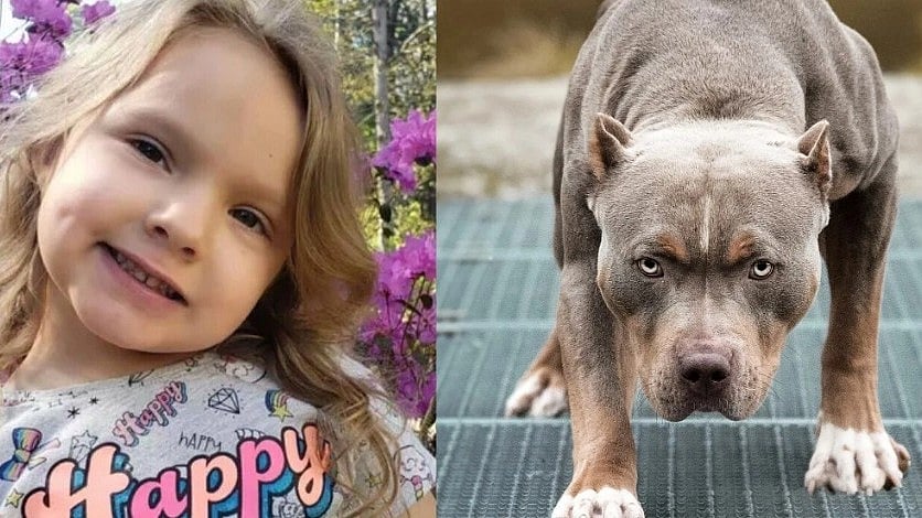 6 வயது சிறுமியை கடித்த பிட்புல் நாய்.. 12 மணி நேர அறுவை சிகிச்சை: முகத்தில் 1000 தையல்கள்!