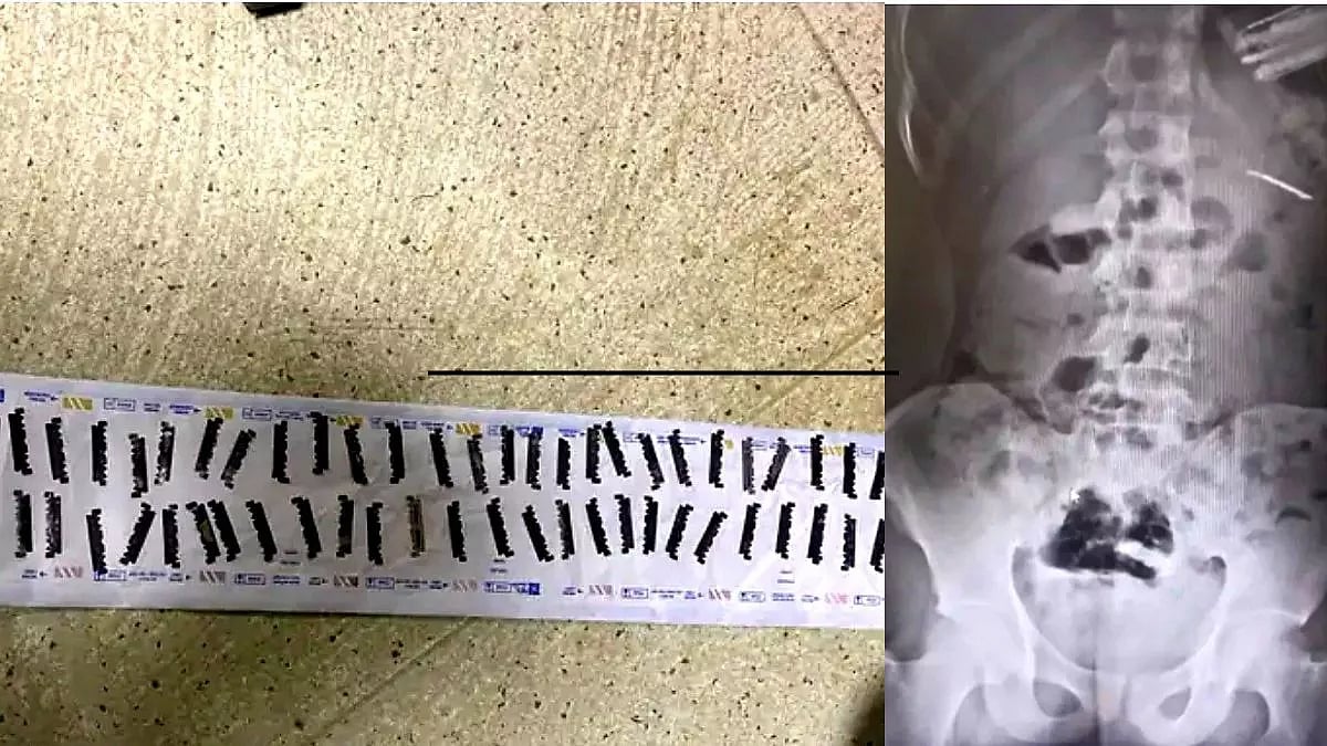 ரத்த வாந்தி எடுத்த இளைஞர்.. வயிற்றில் இருந்த 56 பிளேடுகள்.. பரிசோதனை செய்து அதிர்ந்த மருத்துவர்கள் !