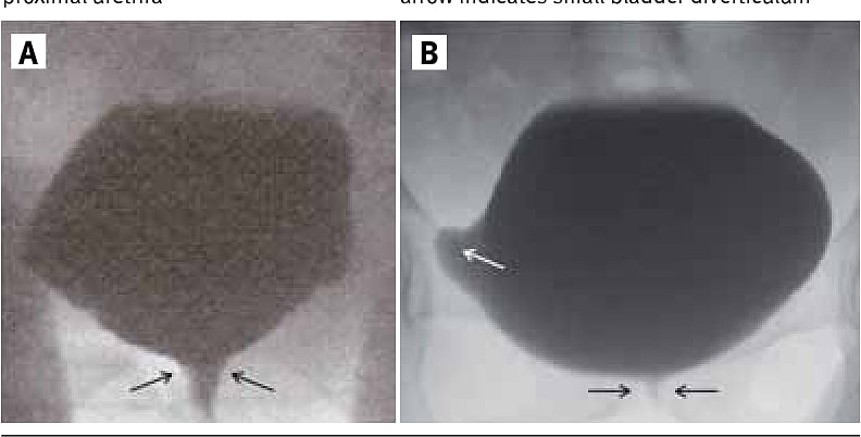 சிறுநீர் கழிக்க முடியாமல் போகும் அரியவகை நோய்.. 14 மாதங்களாக தவித்துவரும் இளம்பெண்ணின் சோகப் பின்னணி !