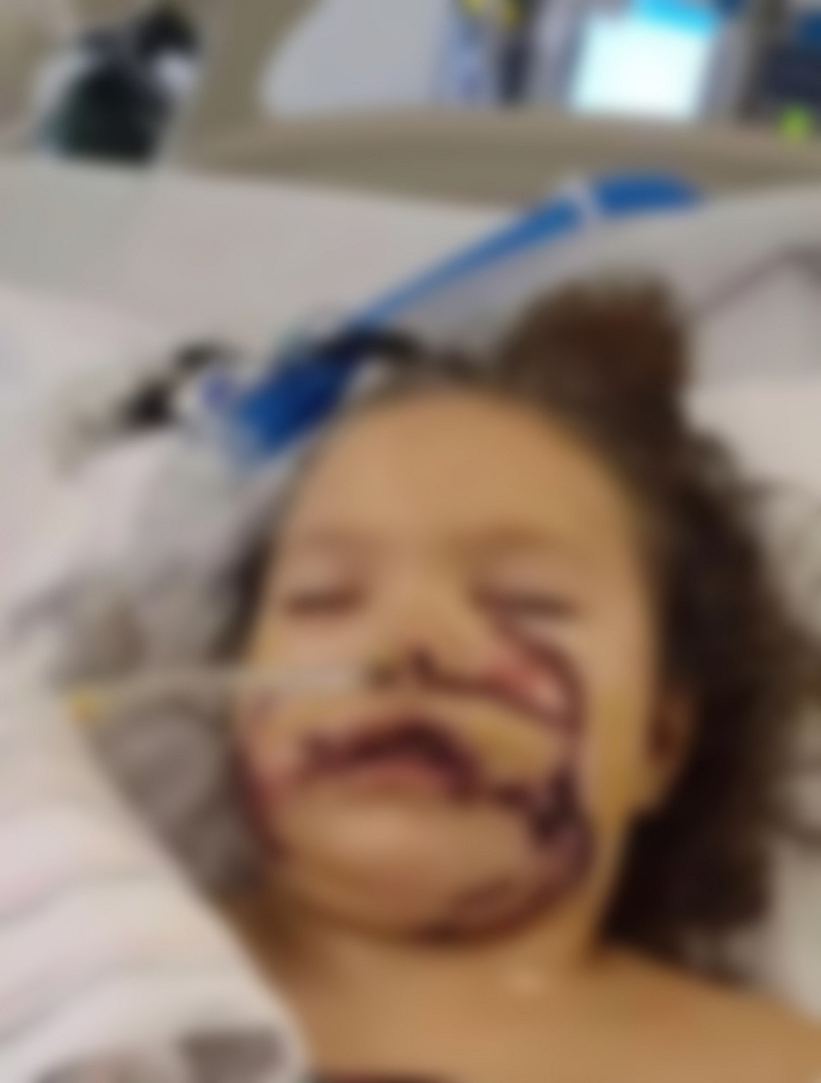 6 வயது சிறுமியை கடித்த பிட்புல் நாய்.. 12 மணி நேர அறுவை சிகிச்சை: முகத்தில் 1000 தையல்கள்!