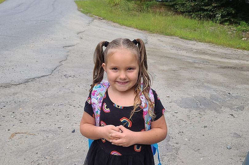 6 வயது சிறுமியை கடித்த பிட்புல் நாய்.. 12 மணி நேர அறுவை சிகிச்சை: முகத்தில் 1000 தையல்கள்!