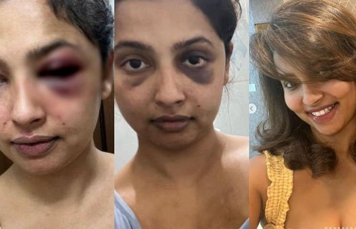 வீங்கிய முகம்.. ரத்த கோரங்களுடன் உடல்: காதலன் தாக்கியதாக இன்ஸ்டாவில் புகைப்படம் பதிவிட்ட தமிழ் பட நடிகை !