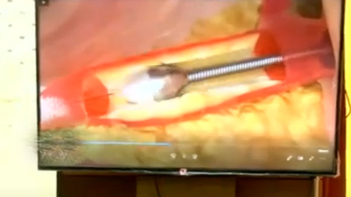 தனியார் மருத்துவமனையில் 8 லட்சம்.. 63 வயது முதியவரின் உயிரை காப்பாற்றி திருச்சி அரசு மருத்துவமனை சாதனை !