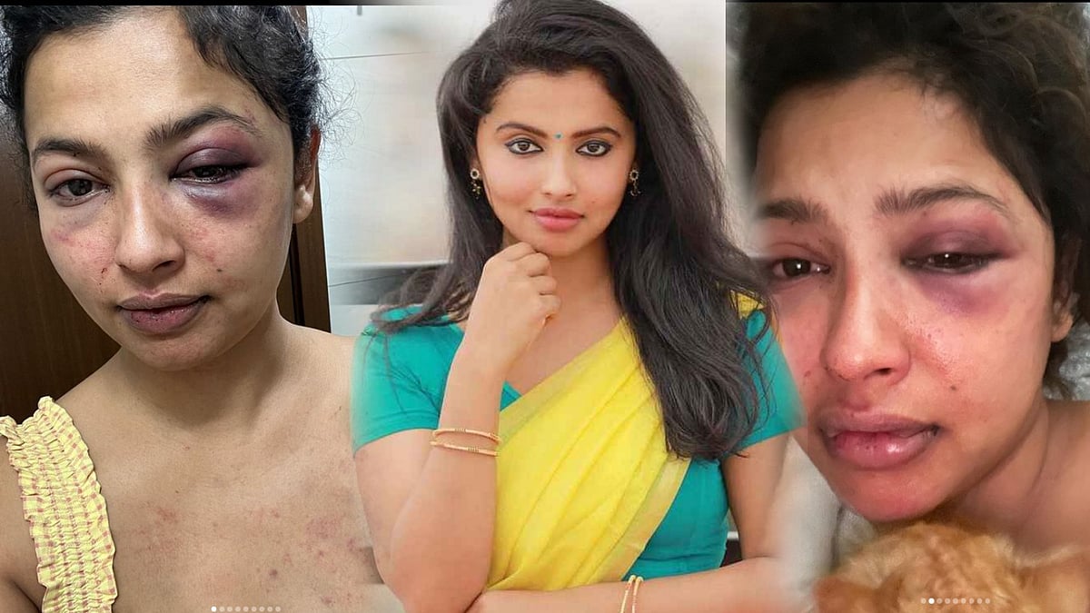 வீங்கிய முகம்.. ரத்த கோரங்களுடன் உடல்: காதலன் தாக்கியதாக இன்ஸ்டாவில் புகைப்படம் பதிவிட்ட தமிழ் பட நடிகை !