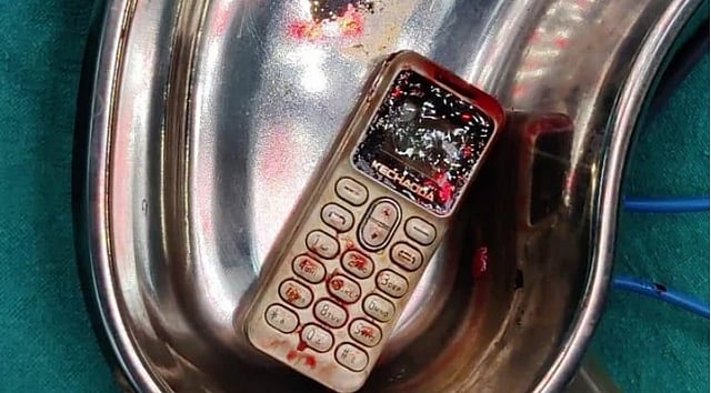 தம்பியுடன் சண்டை.. கோபத்தில் சீன மாடல் செல்போனை விழுங்கிய சகோதரி.. பின்னர் நடந்தது என்ன? -ம.பி-யில் ஷாக்!