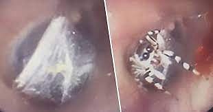 அப்போ மூதாட்டி.. இப்போ இளம்பெண்: காதுக்குள் உயிருடன் கூடு கட்டி வசித்த சிலந்தி-பயங்கரத்தின் பின்னணி என்ன?