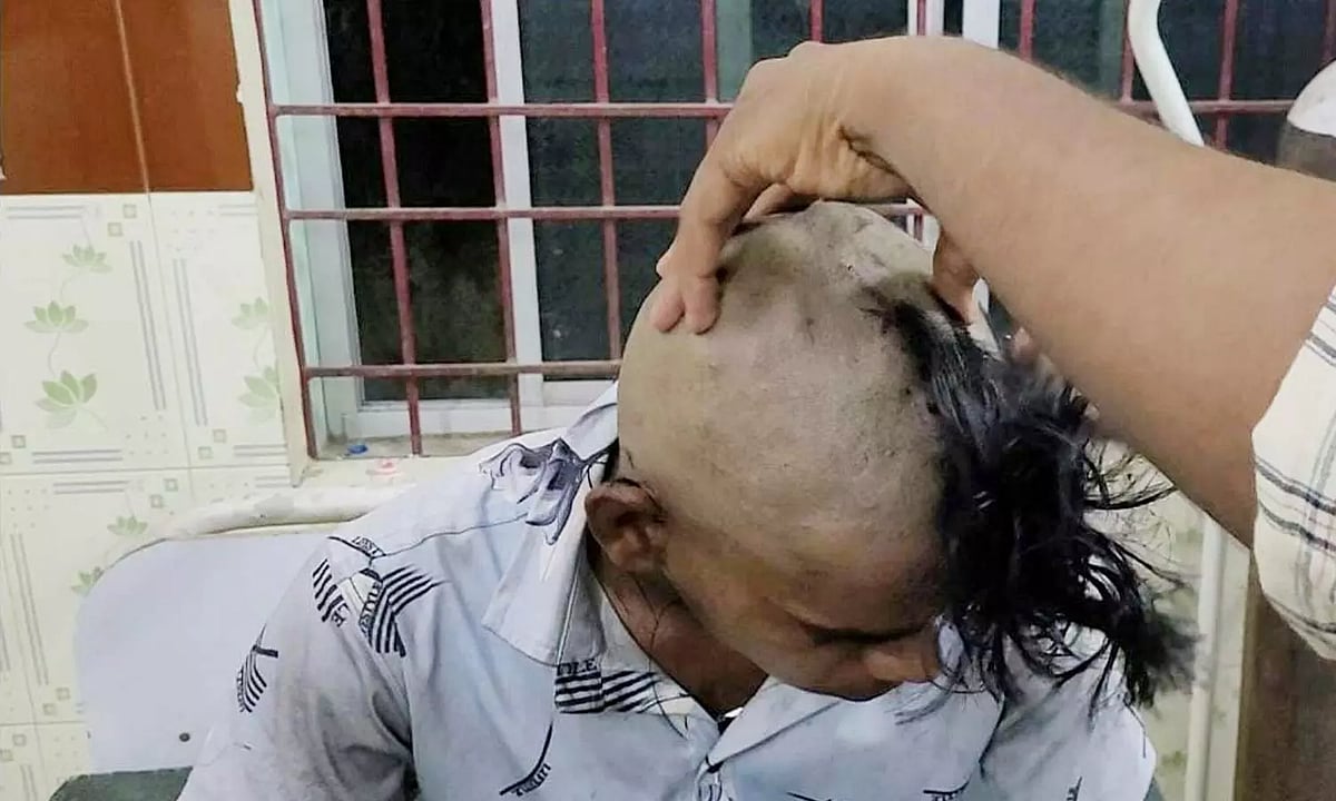 சிறுவனின் காதுக்குள் புகுந்த தேனீ.. உயிருடன் வெளியே எடுத்த மருத்துவர்கள்.. வேலூரில் என்ன நடந்தது ?