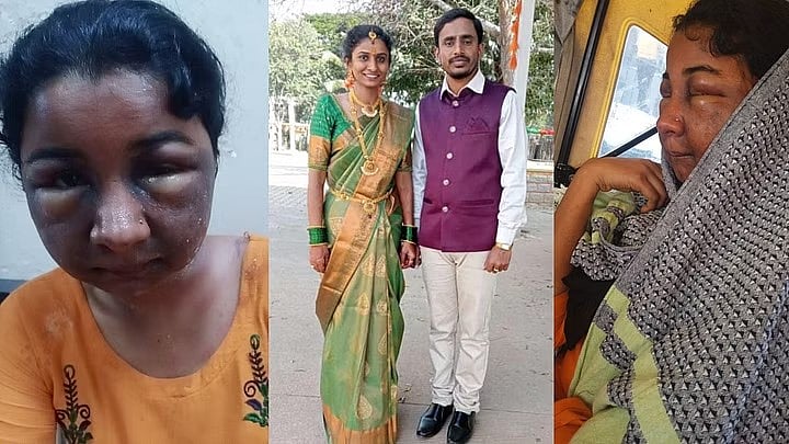 அழகான உதடுக்கு ஆசைப்பட்ட இளம்பெண்.. இலவசமாக கிடைத்த Lip Filler மூலம் நேர்ந்த சோகம்.. குமுறும் மாடல் அழகி!
