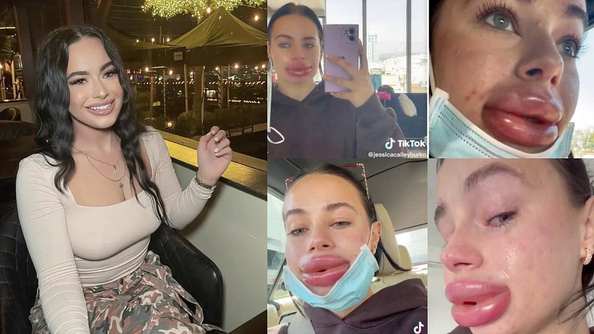 அழகான உதடுக்கு ஆசைப்பட்ட இளம்பெண்.. இலவசமாக கிடைத்த Lip Filler மூலம் நேர்ந்த சோகம்.. குமுறும் மாடல் அழகி!