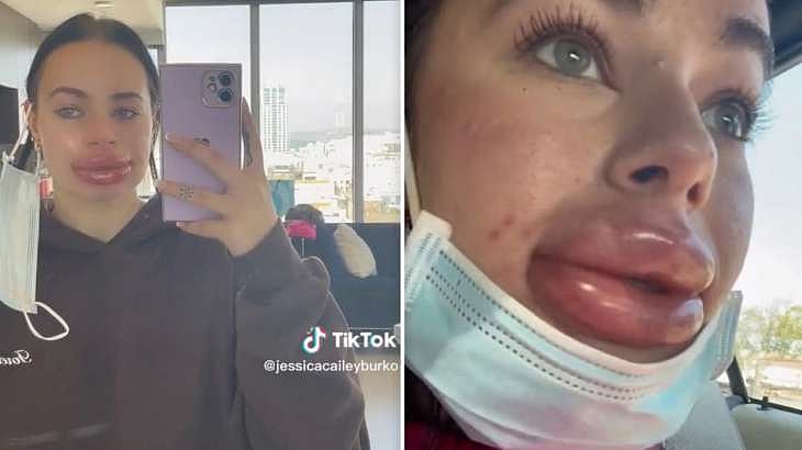 அழகான உதடுக்கு ஆசைப்பட்ட இளம்பெண்.. இலவசமாக கிடைத்த Lip Filler மூலம் நேர்ந்த சோகம்.. குமுறும் மாடல் அழகி!