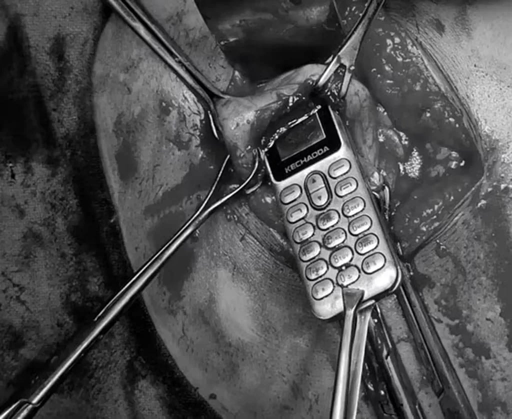 தம்பியுடன் சண்டை.. கோபத்தில் சீன மாடல் செல்போனை விழுங்கிய சகோதரி.. பின்னர் நடந்தது என்ன? -ம.பி-யில் ஷாக்!