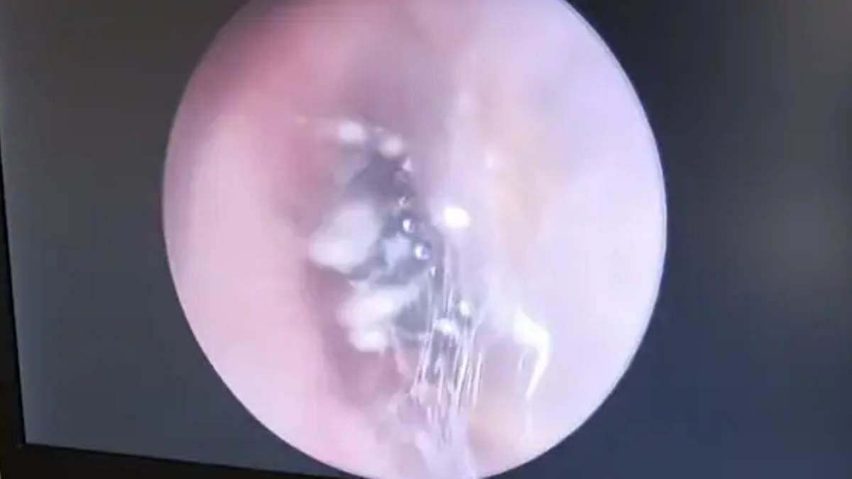 அப்போ மூதாட்டி.. இப்போ இளம்பெண்: காதுக்குள் உயிருடன் கூடு கட்டி வசித்த சிலந்தி-பயங்கரத்தின் பின்னணி என்ன?