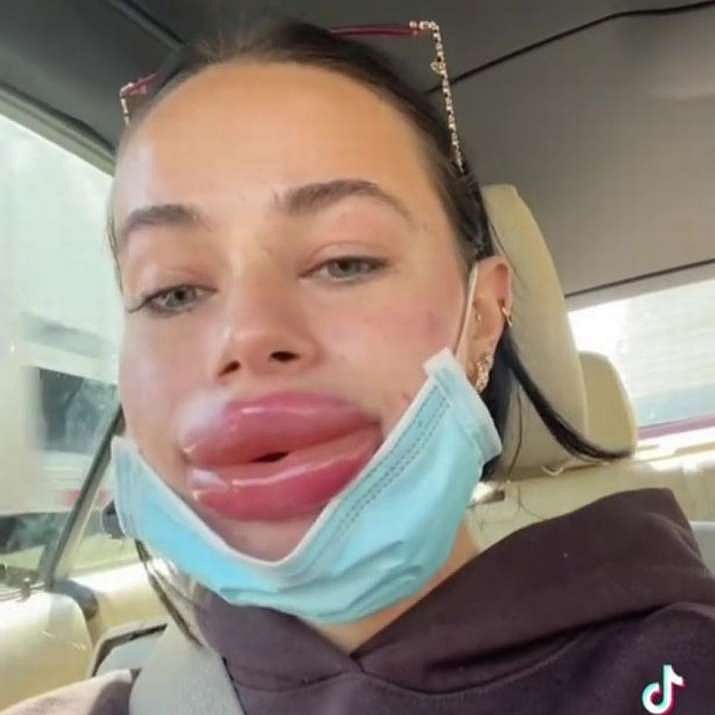 அழகான உதடுக்கு ஆசைப்பட்ட இளம்பெண்.. இலவசமாக கிடைத்த Lip Filler மூலம் நேர்ந்த சோகம்.. குமுறும் மாடல் அழகி!