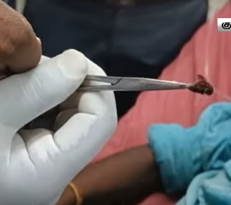 சிறுவனின் காதுக்குள் புகுந்த தேனீ.. உயிருடன் வெளியே எடுத்த மருத்துவர்கள்.. வேலூரில் என்ன நடந்தது ?