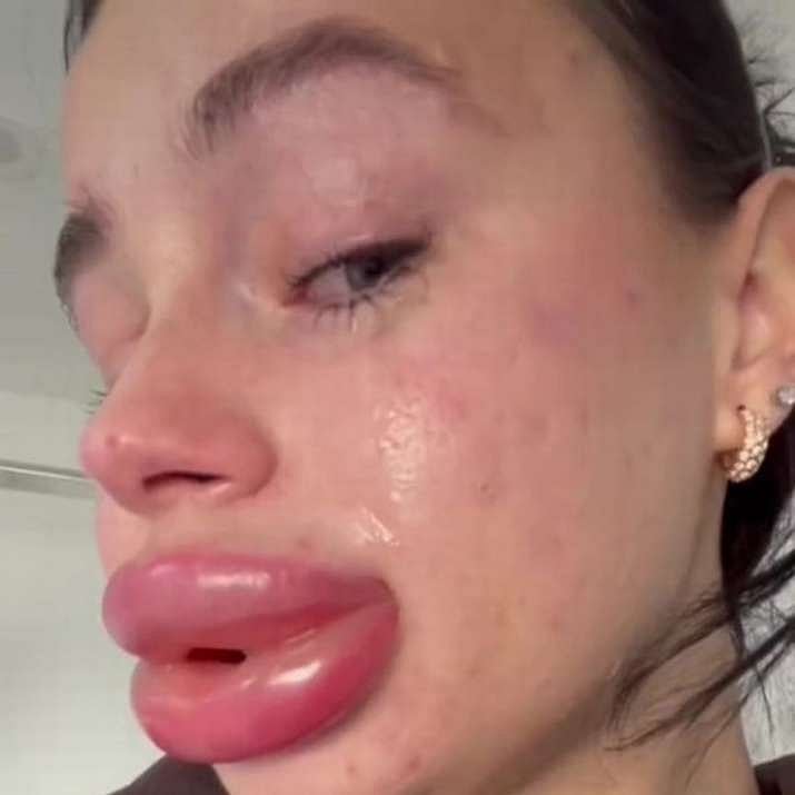அழகான உதடுக்கு ஆசைப்பட்ட இளம்பெண்.. இலவசமாக கிடைத்த Lip Filler மூலம் நேர்ந்த சோகம்.. குமுறும் மாடல் அழகி!