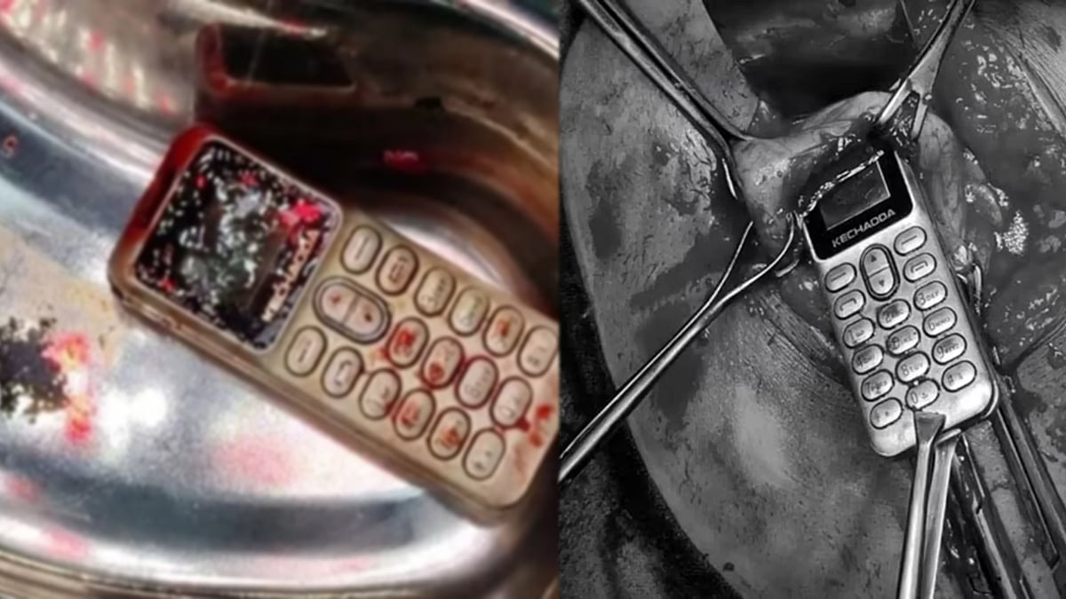 தம்பியுடன் சண்டை.. கோபத்தில் சீன மாடல் செல்போனை விழுங்கிய சகோதரி.. பின்னர் நடந்தது என்ன? -ம.பி-யில் ஷாக்!