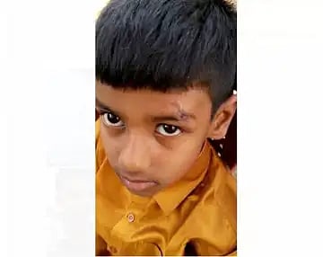 தெலுங்கானா: சிறுவனுக்கு புருவத்தில் ஏற்பட்ட காயம்.. தையலுக்கு பதில் பெவிகுயிக் போட்டு ஒட்டிய மருத்துவமனை!