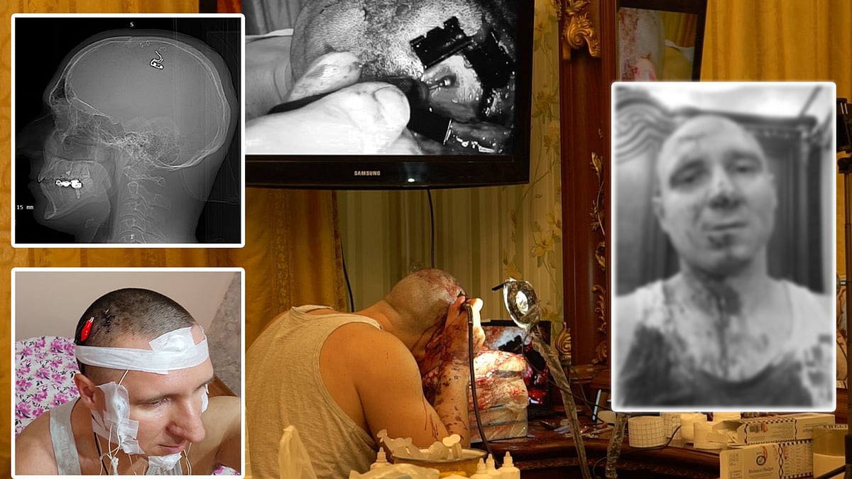 ட்ரில்லிங் மிஷினில் ஓட்டை.. மூளையில் சிப் பொறுத்த எண்ணி தனக்கு தானே Operation: விபரீதத்தில் முடிந்த கனவு!