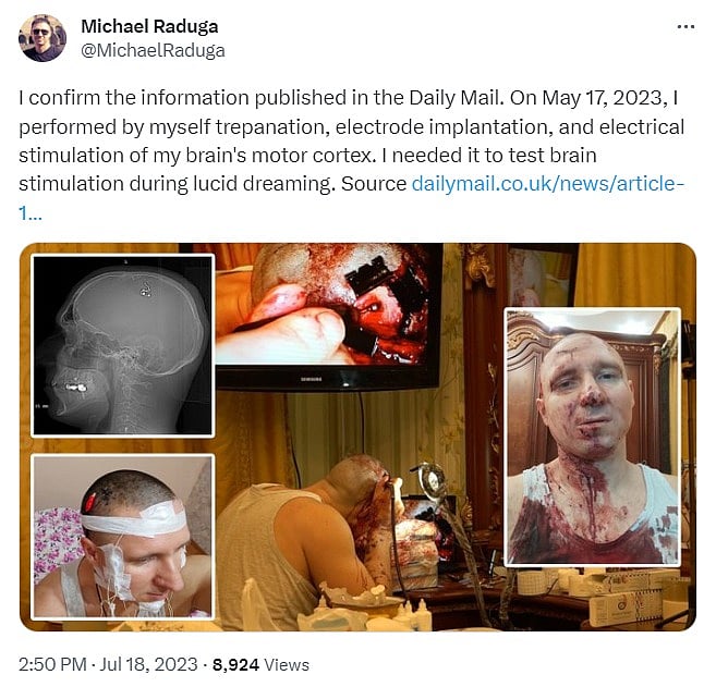 ட்ரில்லிங் மிஷினில் ஓட்டை.. மூளையில் சிப் பொறுத்த எண்ணி தனக்கு தானே Operation: விபரீதத்தில் முடிந்த கனவு!