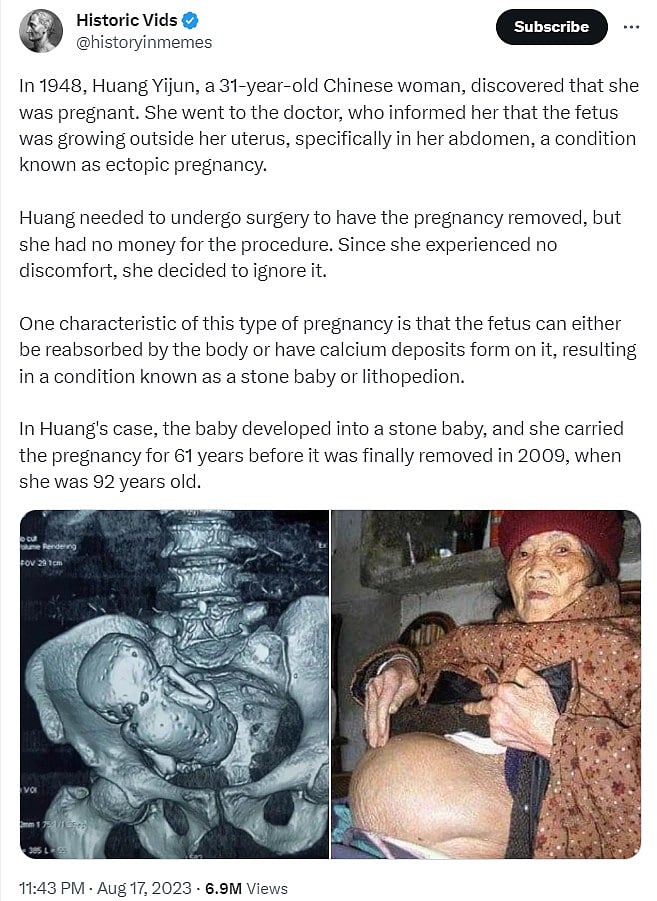 31 வயதில் கருத்தரிப்பு.. வயிற்றிலே இறந்து கல்லான குழந்தையை 92 வயதில் நீக்கிய மருத்துவர்கள் ! - பின்னணி ?