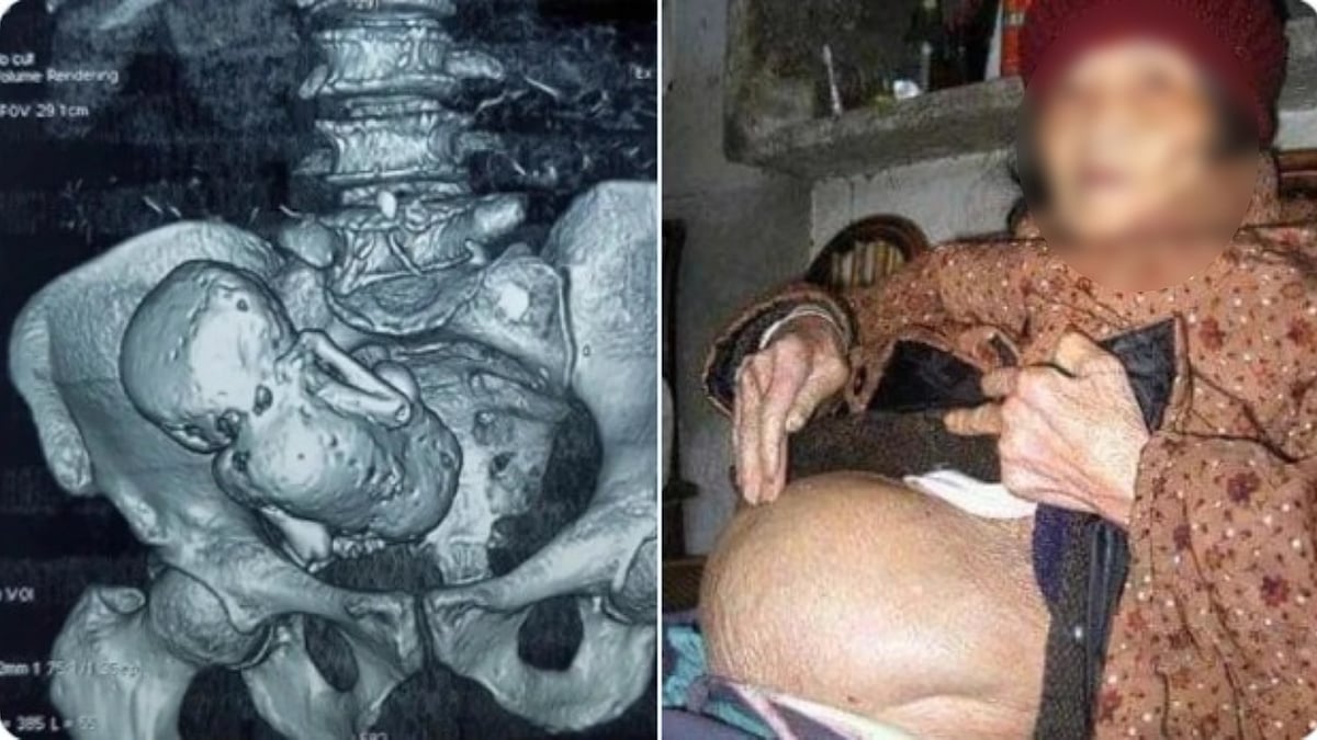 31 வயதில் கருத்தரிப்பு.. வயிற்றிலே இறந்து கல்லான குழந்தையை 92 வயதில் நீக்கிய மருத்துவர்கள் ! - பின்னணி ?