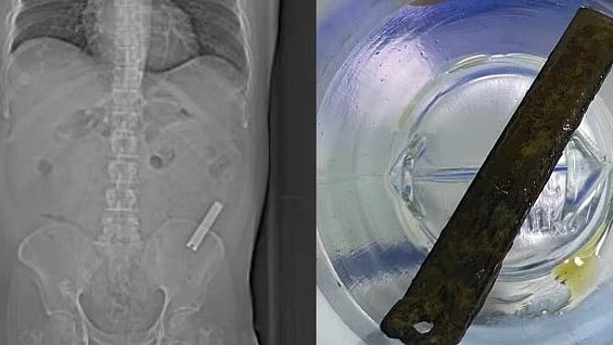 8 வருடமாக வயிற்றில் இருந்த  நகவெட்டி.. வாலிபர் சொன்ன காரணத்தைக் கேட்டு அதிர்ச்சியடைந்த மருத்துவர்கள்!