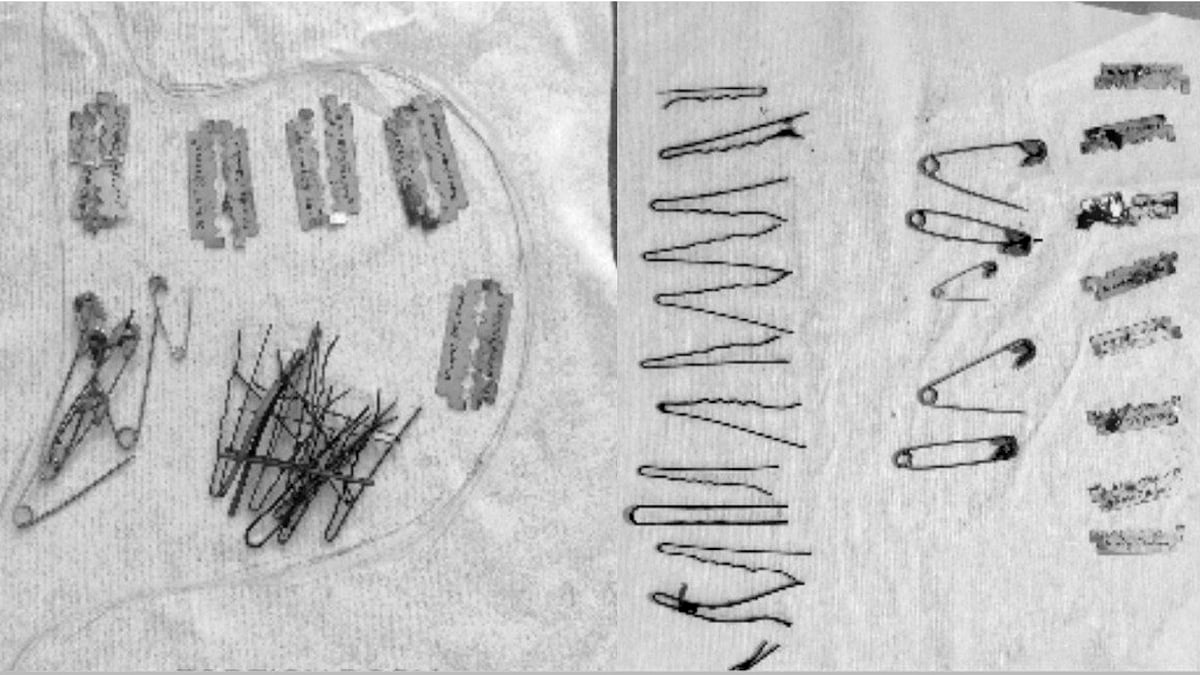 வயிறுவலியால் அவதிப்பட்ட நபர்.. Scan செய்ததில் ஹேர்பின்கள், பிளேடுகள், ஊக்குகளை கண்டறிந்த மருத்துவர்கள்!