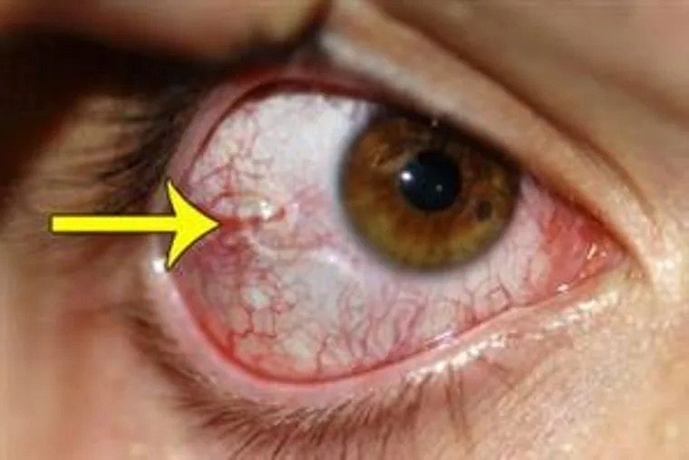 இளம்பெண் கண்ணில் அரிப்பு... பரிசோதனையில் கண்களில் இருந்த 60 உயிருள்ள புழுக்கள் - ஷாக்கான மருத்துவர்கள் !