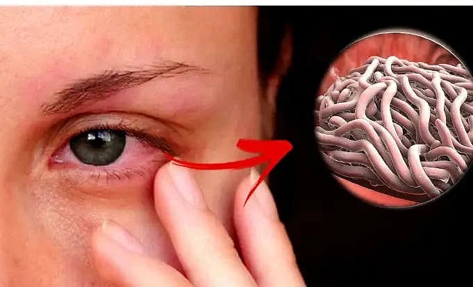 இளம்பெண் கண்ணில் அரிப்பு... பரிசோதனையில் கண்களில் இருந்த 60 உயிருள்ள புழுக்கள் - ஷாக்கான மருத்துவர்கள் !