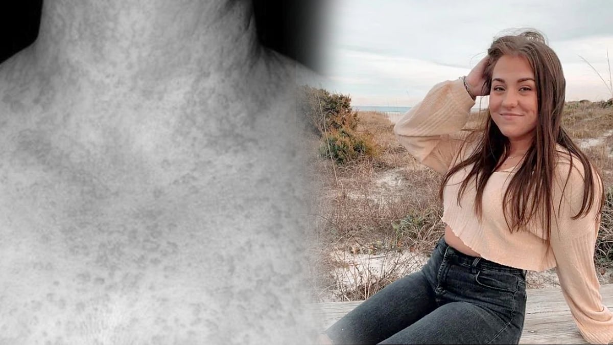 உலகிலேயே அரிதான நோய்... ‘குளித்தால் அலர்ஜி’... 22 வயது இளம்பெண்ணின் பரிதாப நிலை ! 