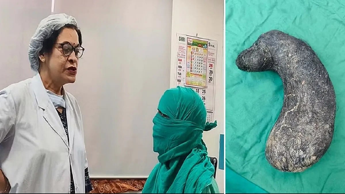 வயிறு வலியால் துடித்த இளம்பெண்... பரிசோதனையில் அதிர்ச்சி... 2.5 கிலோ முடி அகற்றம்!