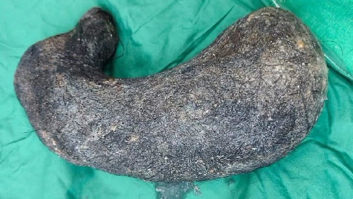 வயிறு வலியால் துடித்த இளம்பெண்... பரிசோதனையில் அதிர்ச்சி... 2.5 கிலோ முடி அகற்றம்!