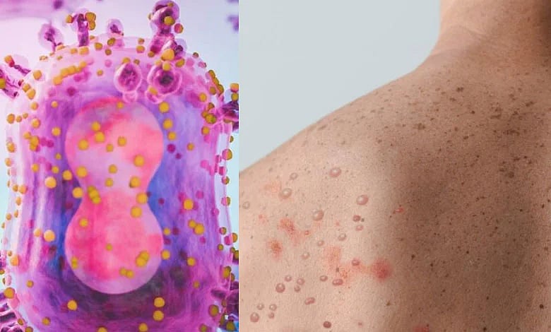 உலகை அச்சுறுத்தும் குரங்கம்மை நோய் : இந்தியாவில் இளைஞர் ஒருவருக்கு அறிகுறி - ஒன்றிய அரசு அதிர்ச்சி தகவல்!