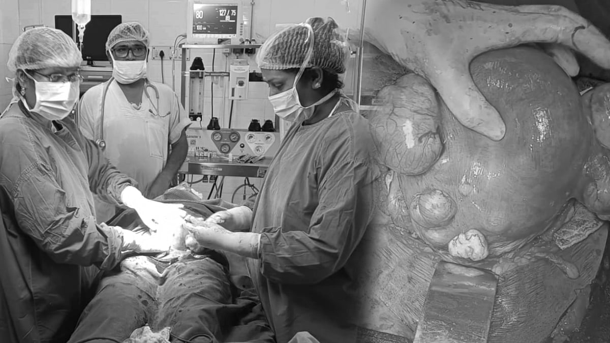 வயிறு வலியால் துடித்த பெண்... 5 கிலோ கட்டியை வெற்றிகரமாக அகற்றி சாதித்த மணப்பாறை அரசு மருத்துவமனை !