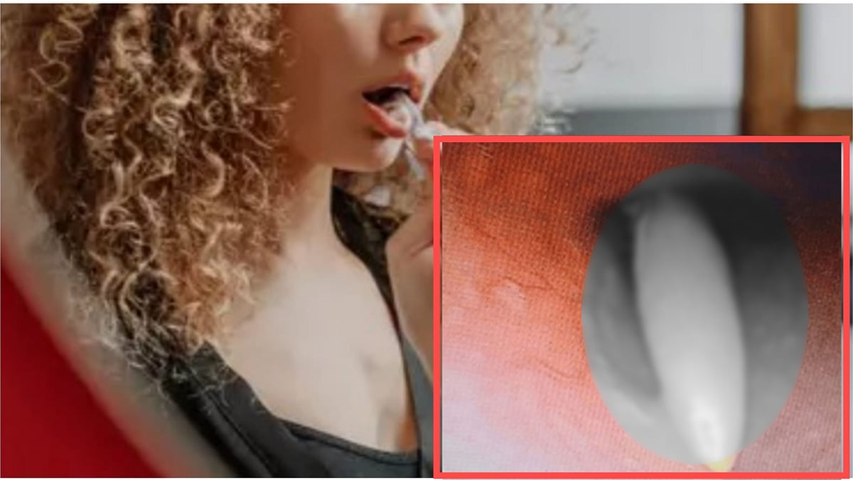 தெரியாமல் 20 செ.மீ. Tooth Brush-ஐ விழுங்கிய பெண்... ஷாக்கான மருத்துவர்கள்... பிறகு நடந்தது என்ன?