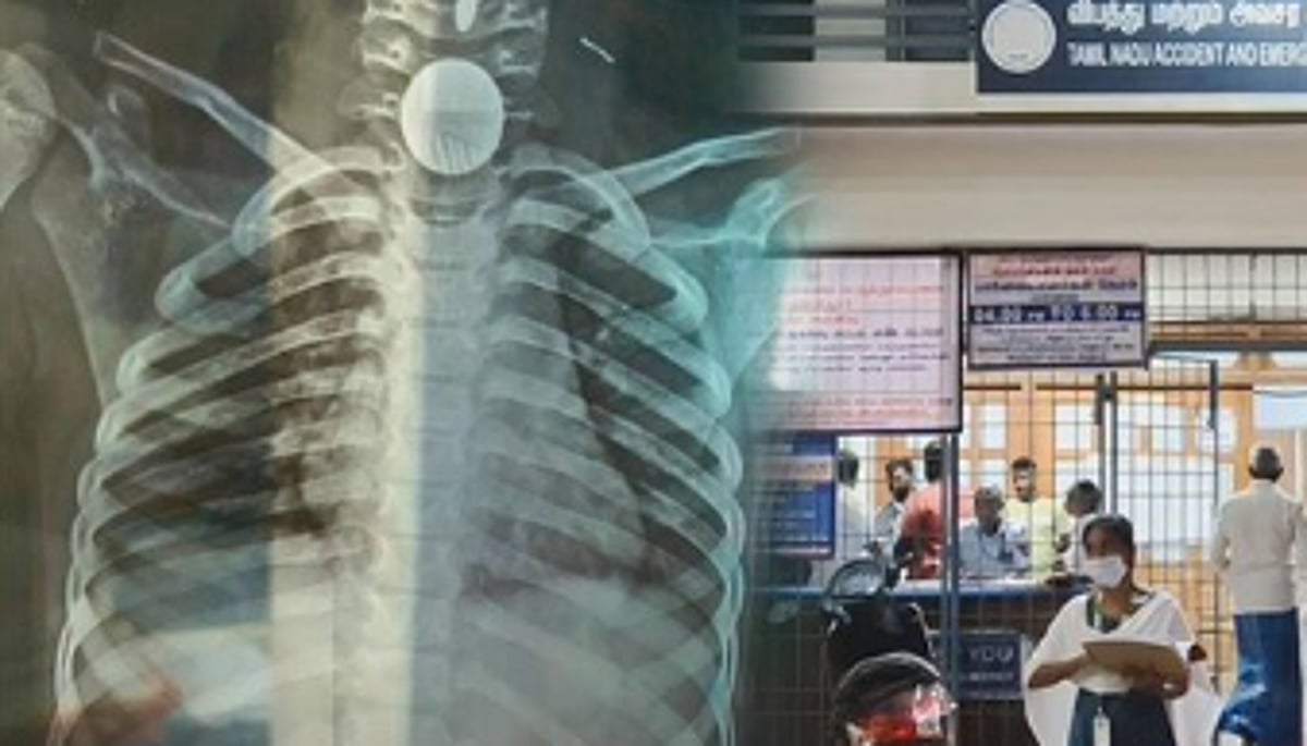 கைவிட்ட தனியார் மருத்துவமனை - 7 வயது சிறுமியின் உயிரை காப்பாற்றிய அரசு மருத்துவமனை!