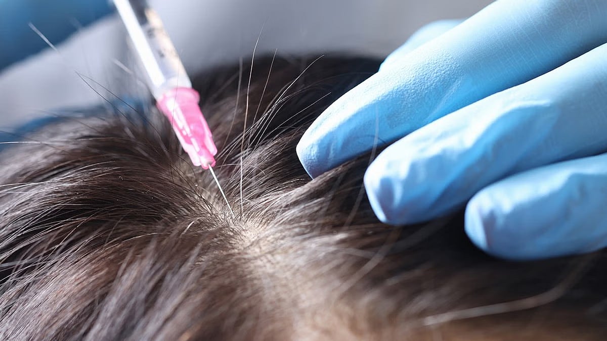 முடிமாற்று அறுவை சிகிச்சை செய்த பல் மருத்துவர்.. 2 பேருக்கு நேர்ந்த சோகம்.. உ.பி-யை உலுக்கிய நிகழ்வு!