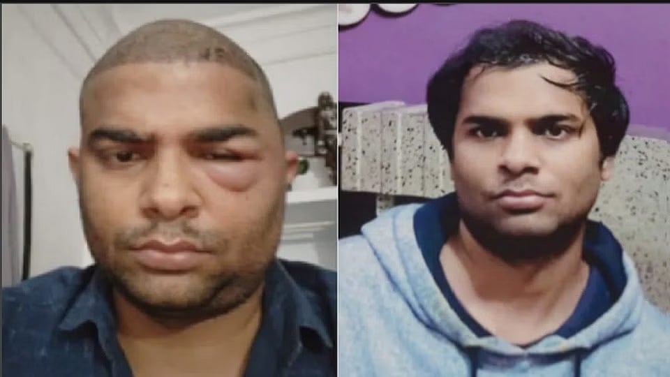 முடிமாற்று அறுவை சிகிச்சை செய்த பல் மருத்துவர்.. 2 பேருக்கு நேர்ந்த சோகம்.. உ.பி-யை உலுக்கிய நிகழ்வு!