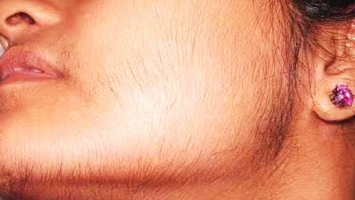 முகத்தில் வளரும் தேவையற்ற பூனை முடிகளை அகற்ற…