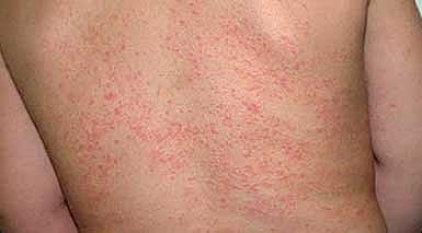 Boy with prickly heat