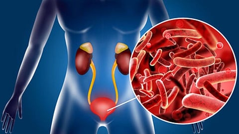 Urinary Tract Infection 