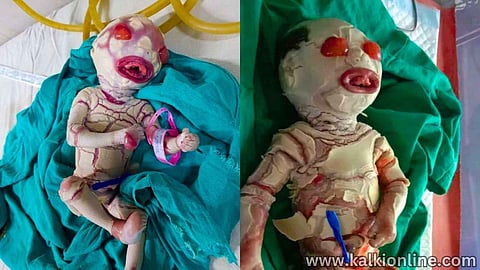 Harlequin Ichthyosis