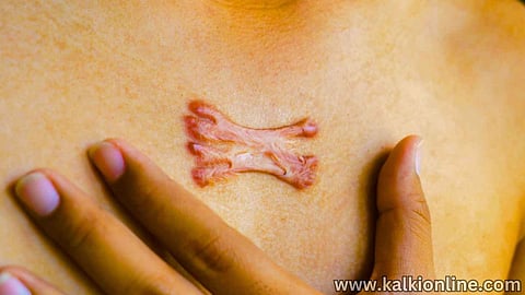 keloid Scars