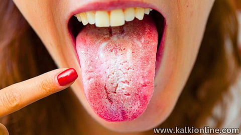 Geographic Tongue