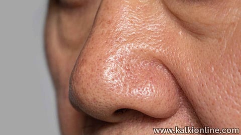 Open Pores on the skin.