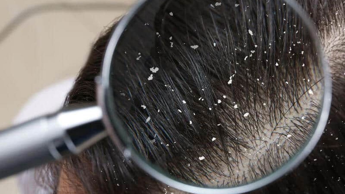 சட்டை காலர் முழுக்க வெள்ளை வெள்ளையா? பொடுகை விரட்ட பாட்டி சொன்ன சீக்ரெட்!